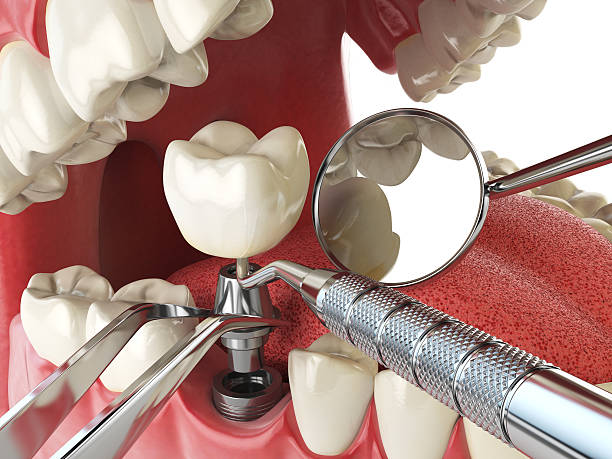 Best Emergency Tooth Extraction in Chillicothe, MO